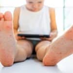 Tout savoir sur le syndrome pieds-mains-bouche 28 Un enfant atteint du syndrome pieds-mains-bouche