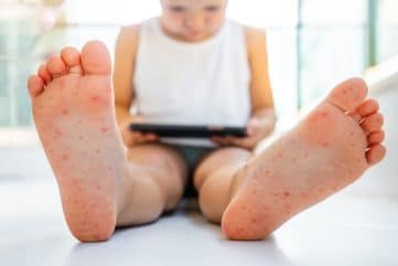 Tout savoir sur le syndrome pieds-mains-bouche 29 Un enfant atteint du syndrome pieds-mains-bouche